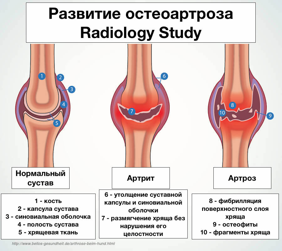 остеоартроз классификация
