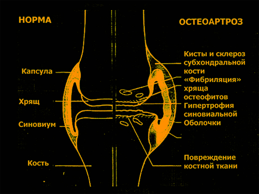 Artroza gradului 2 al articulației genunchiului cu tratament
